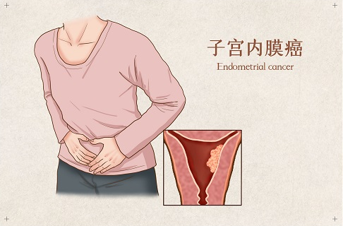 子官内膜癌的常见发病因素-薛医生