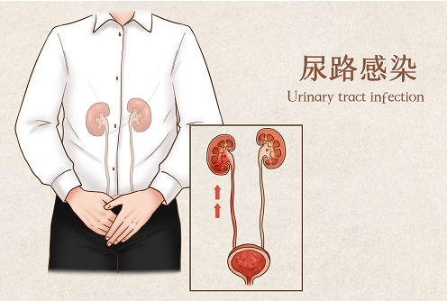男性尿路感染有哪些症状-薛医生