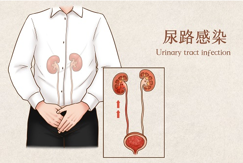 尿路真菌感染是怎么引起的？原因找到了……