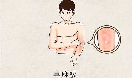 为什么荨麻疹总是反复发作-薛医生