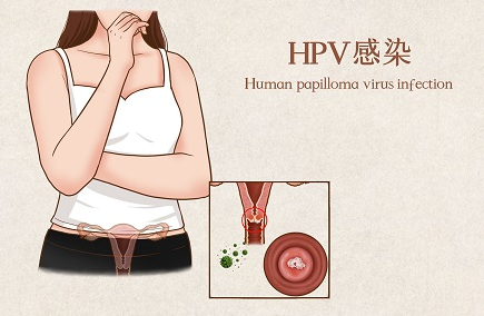 高危型hpv53阳性可以性生活吗？hpv不同型号的危害性！