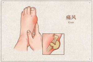 痛风怎么办