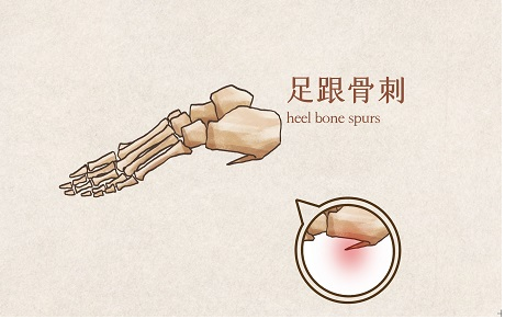 骨刺容易出现在哪些部位-薛医生