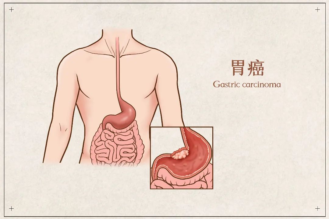 中国拥有全球一半胃癌患者，如何预防？