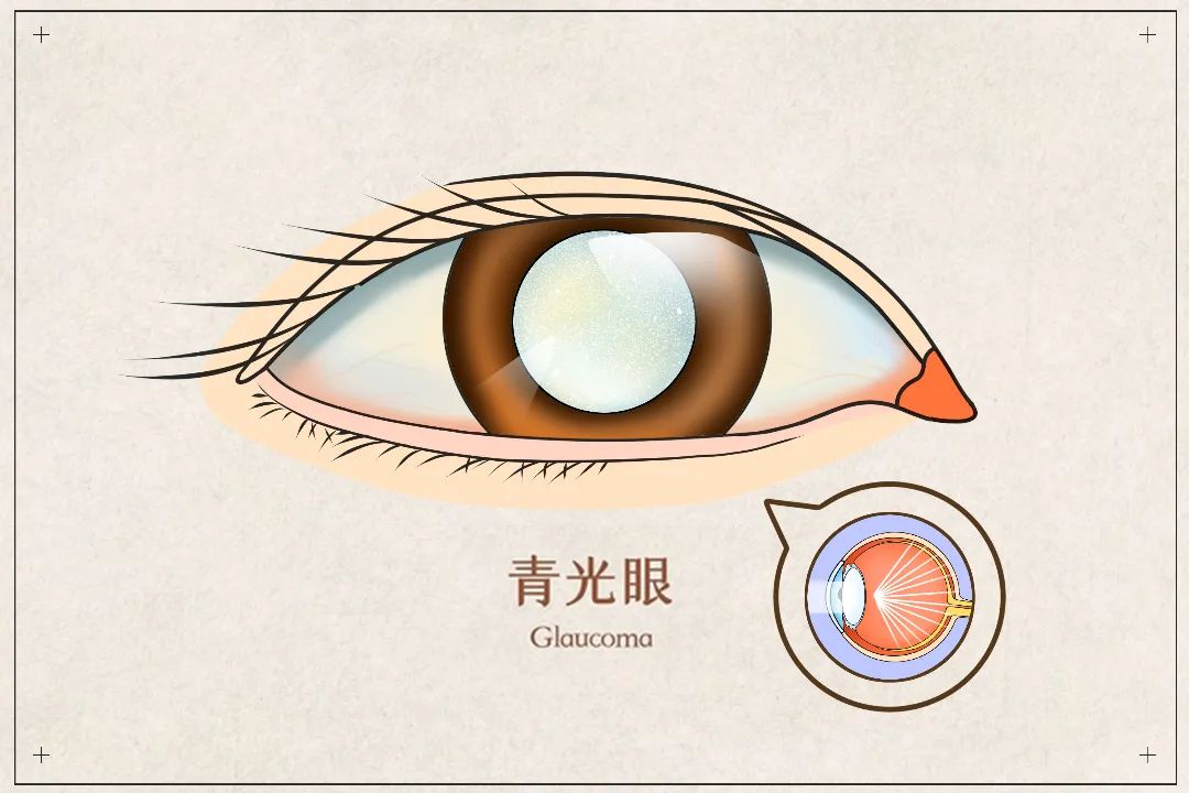 青光眼早期有哪些症状呢-薛医生