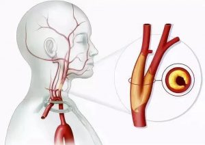 颈动脉硬化只是简单的血管老化？其实暗藏风险！-薛医生