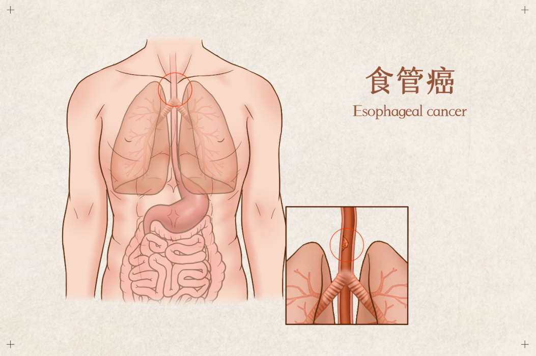 吃这些食物容易致癌，很多人经常在吃-薛医生