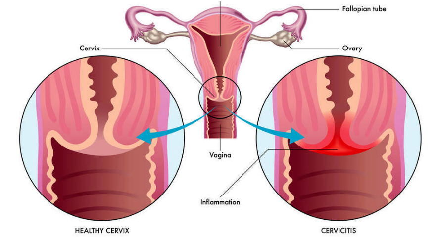 十个女人九个“炎”？远离妇科炎症，你需要知道这些事-薛医生