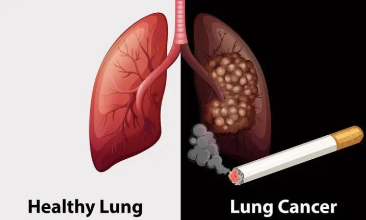 丈夫吸烟近50年，夫妻同患肺癌！都是香烟惹的祸！