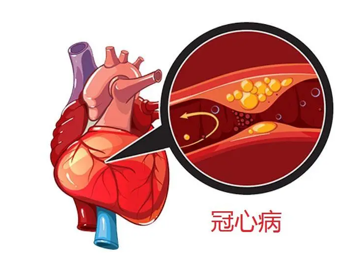 心病有哪些症状，如何治疗？-薛医生