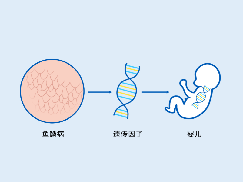 鱼鳞病是什么，如何治疗，怎么治疗？-薛医生