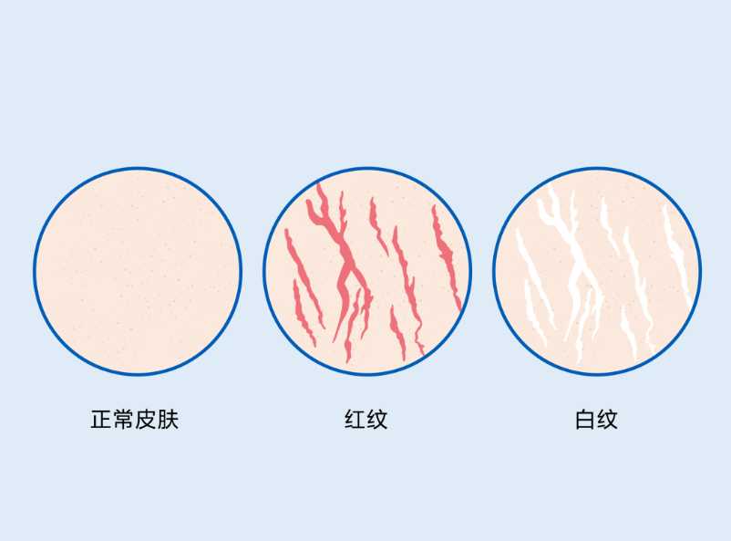 萎缩纹是如何形成的？如何预防和治疗萎缩纹？-薛医生