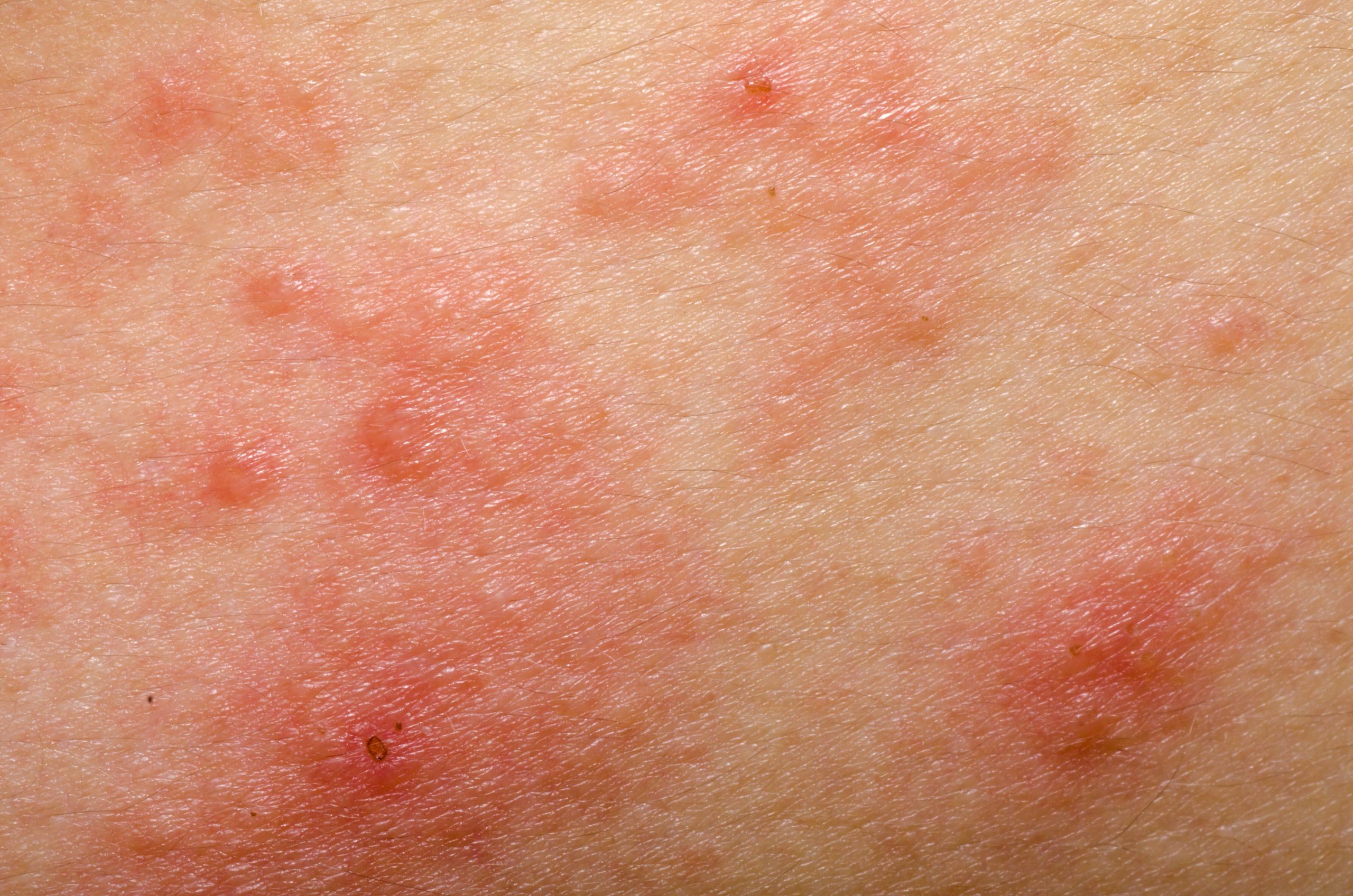 湿疹是什么原因造成的，怎么除根？——薛医生
