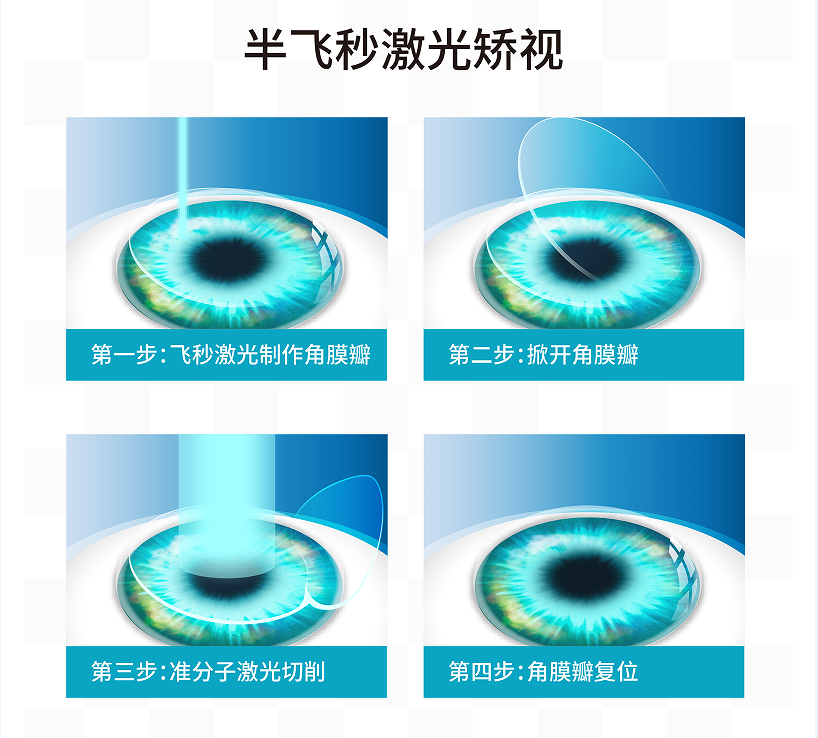 近视眼手术的风险和后遗症有哪些？——薛医生