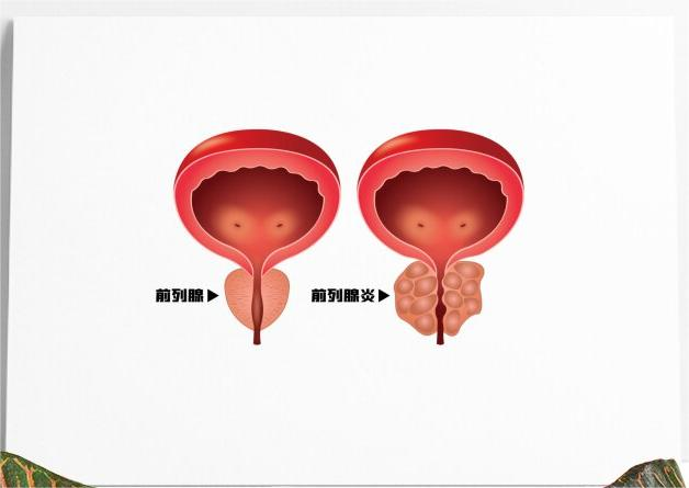 年纪轻轻怎么就不行了呢？薛医生告诉您是不是前列腺炎搞的鬼？